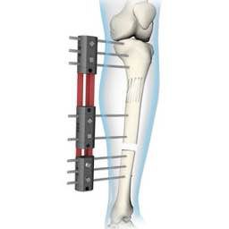 Tashqi osteosintez